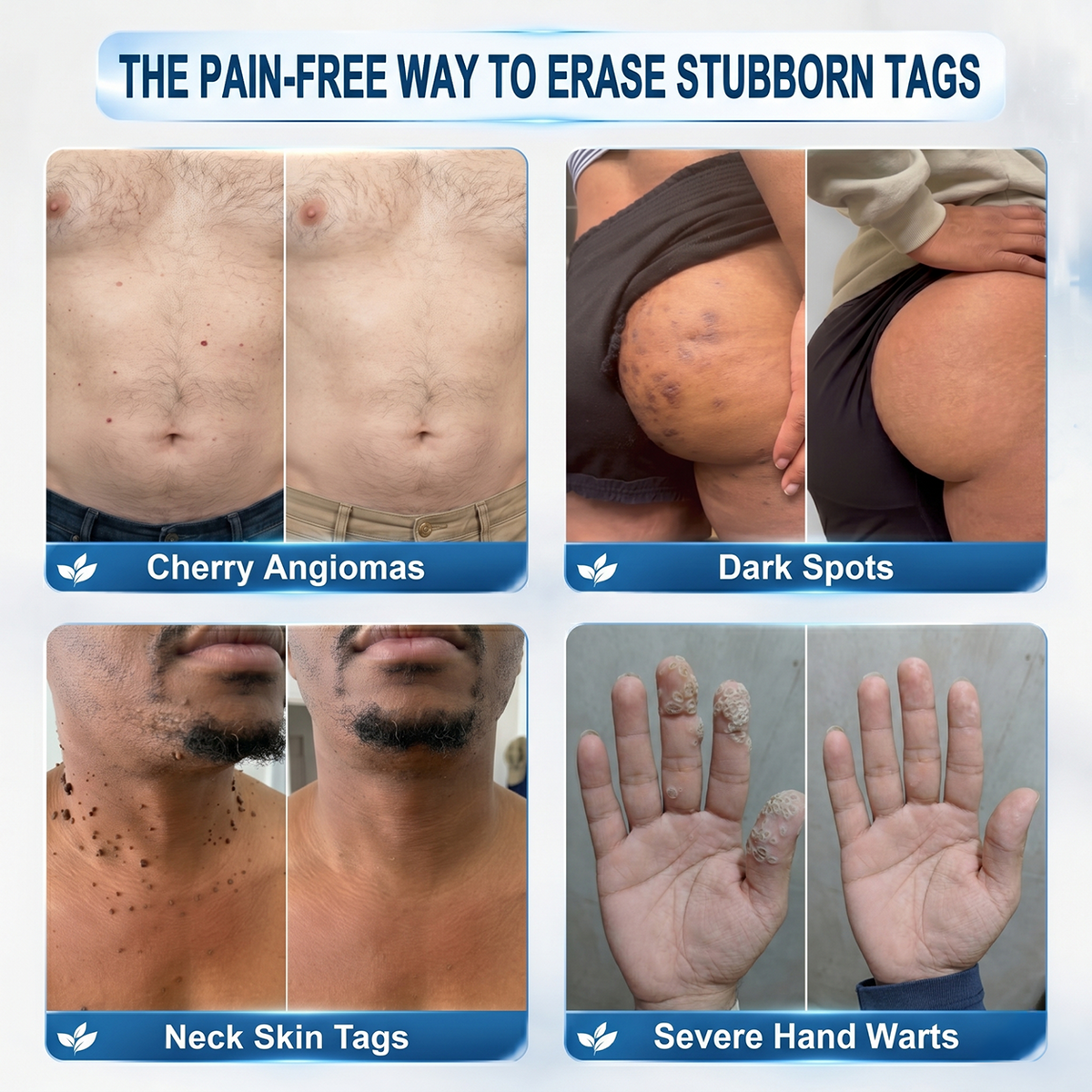 HISKIN® Skin Tag & Spot Eraser Pen