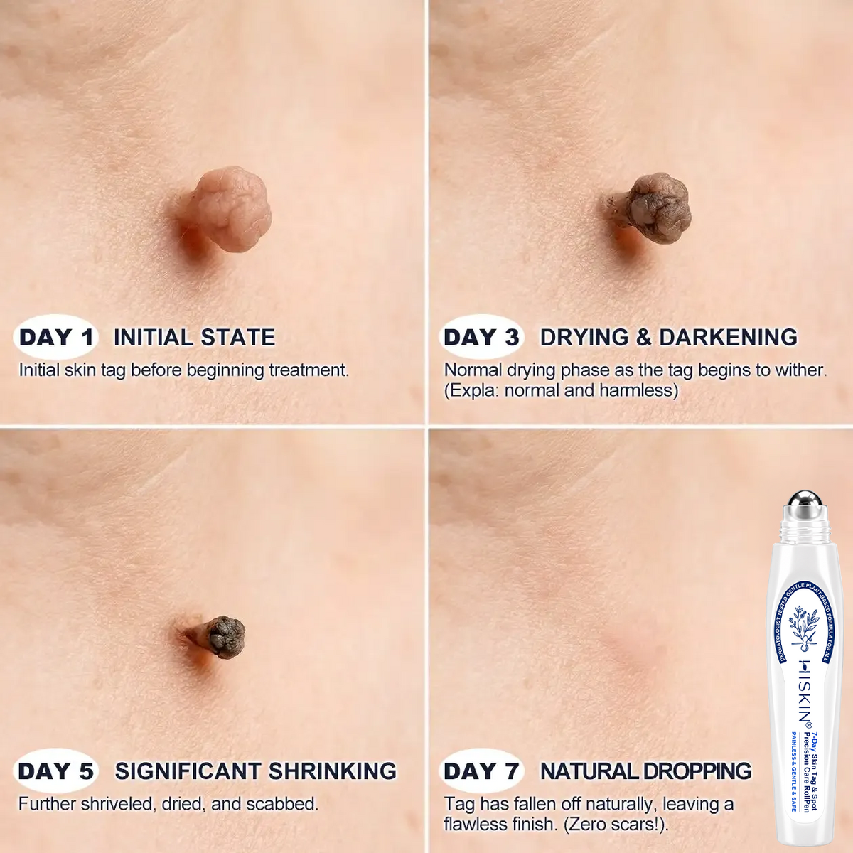 HISKIN® Skin Tag & Spot Eraser Pen