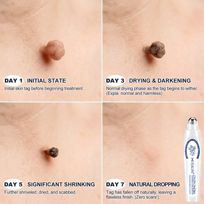 HISKIN® Skin Tag & Spot Eraser Pen